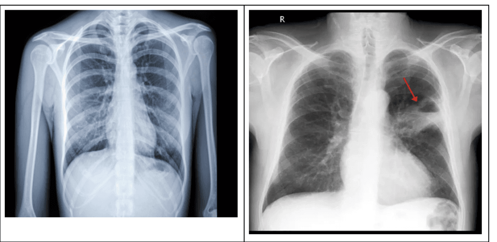 x-ray of a lung cancer patient